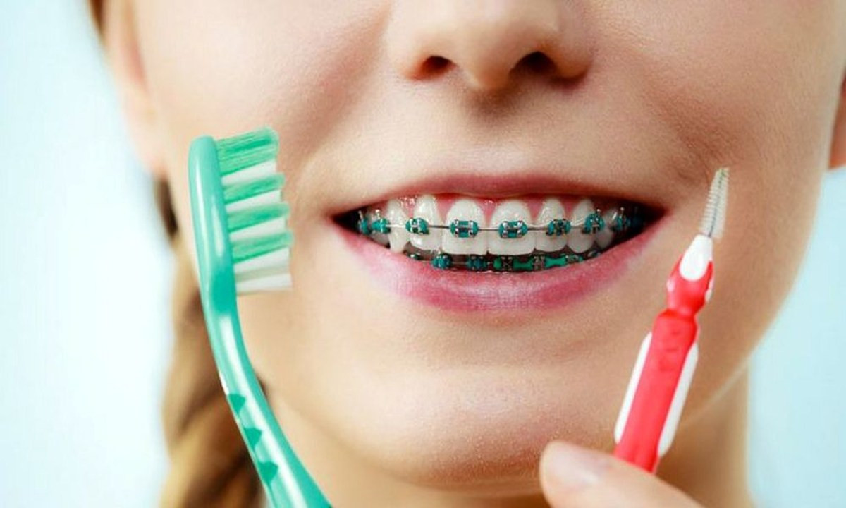 Higiene dental ortodoncia x2