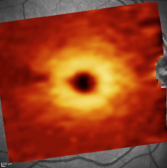 Fondo de ojo donde se representa el mapa del espesor de las cu00e9lulas ganglionares a nivel macular