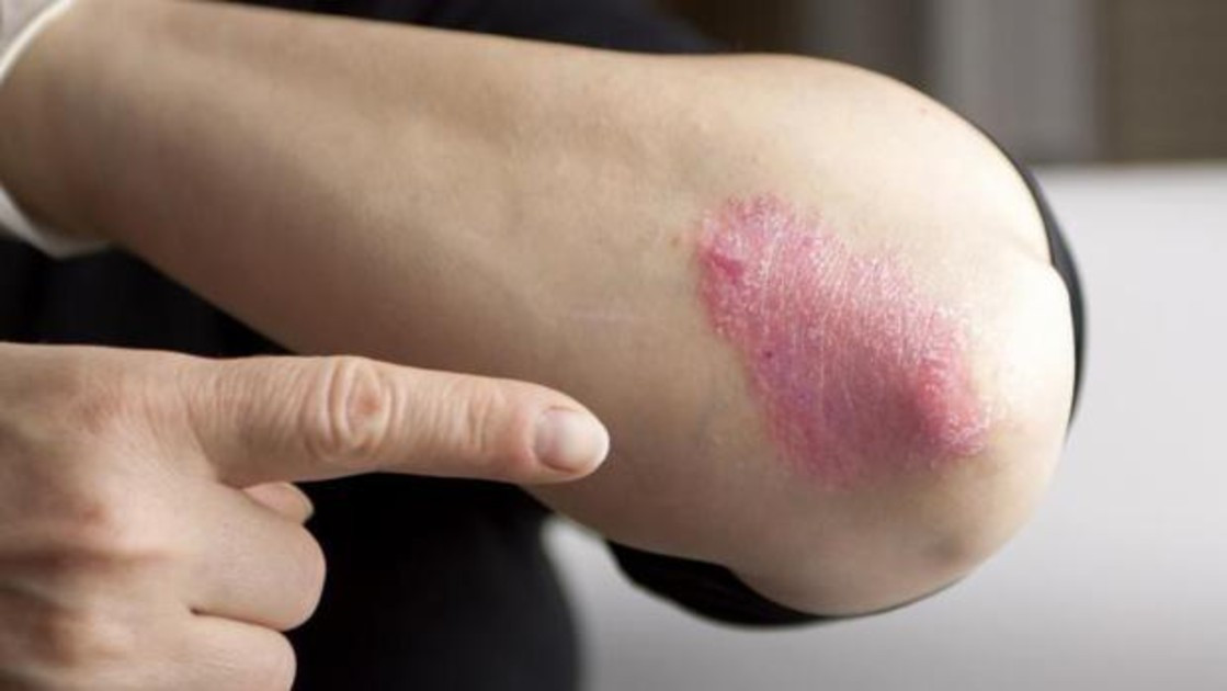 Psoriasis sintomas knqB 1200x630@abc