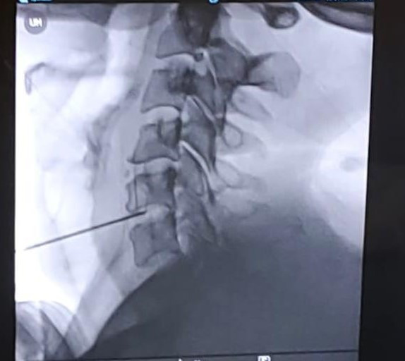 Tu00e9cnica hernia cervical